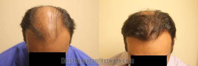 Top view before and after hair restoration results