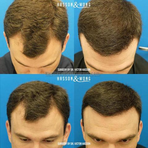 Hair transplantation surgery before and after photos