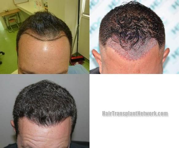 Hair transplantation surgery before and after photos