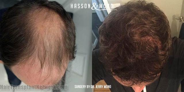 Hair restoration procedure before and after results