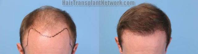 Hair restoration procedure before and after result photos