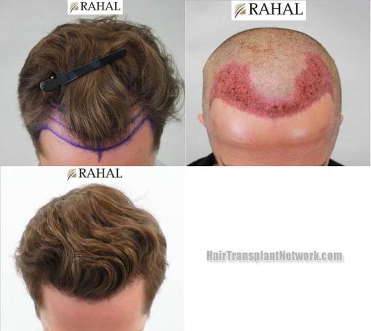 Before and after hair transplant procedure images