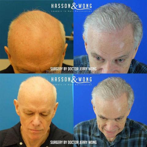 Hair transplantation surgery before and after images