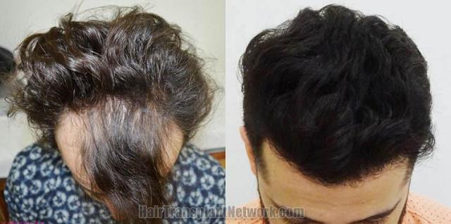 Hair transplantation surgery before and after images