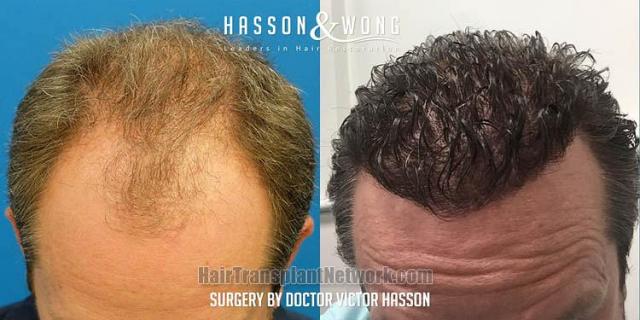 Before and after hair restoration procedure images