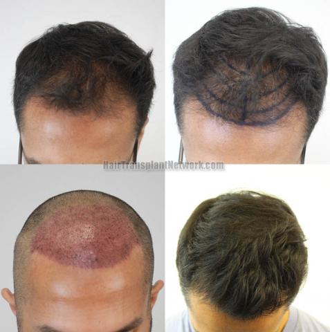 Before and after hair restoration procedure images