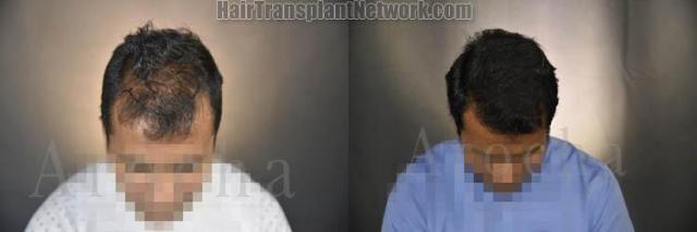 Before and after hair restoration procedure images