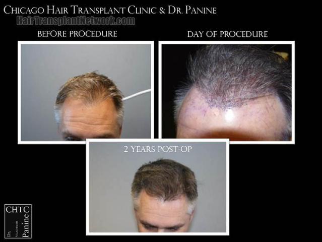 Before and after hair restoration procedure images