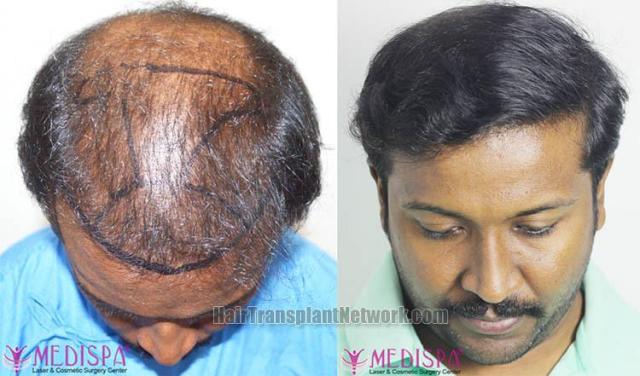 Hair restoration procedure before and after results