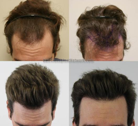 Before and after hair restoration procedure images