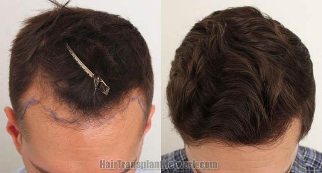 Hair transplantation surgery before and after images