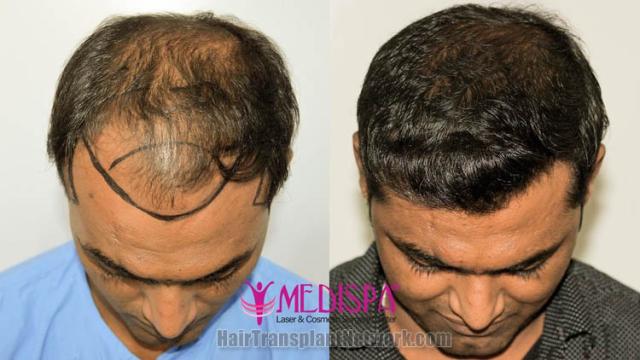 Before and after hair restoration procedure images