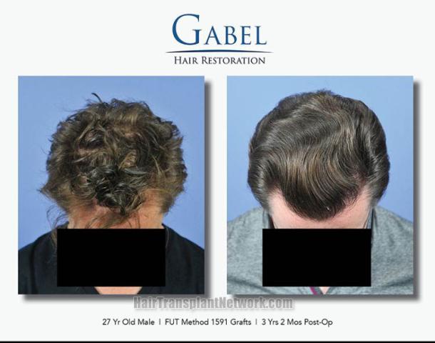 Before and after hair restoration procedure images