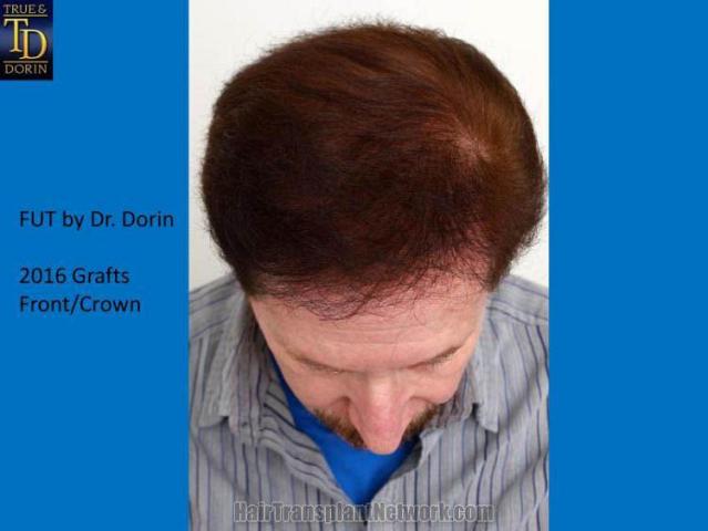 Hair restoration surgery before and after images