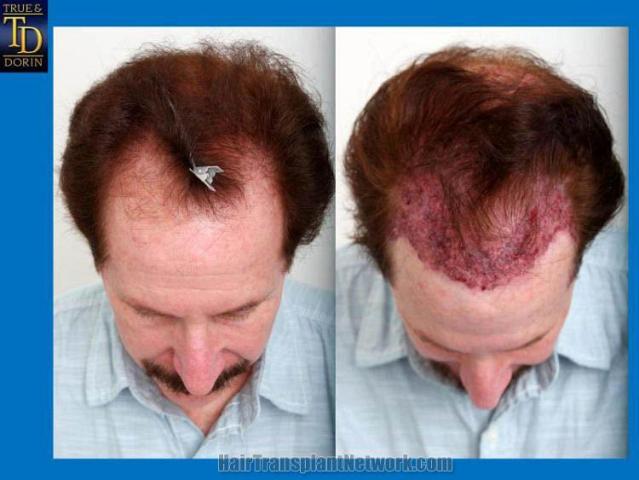 Hair transplantation surgery before and after photos