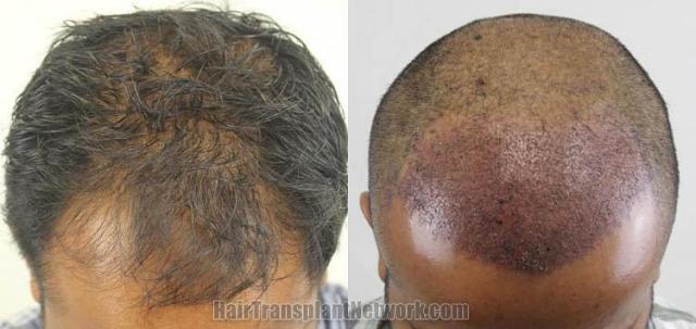 Hair transplantation surgery before and after images