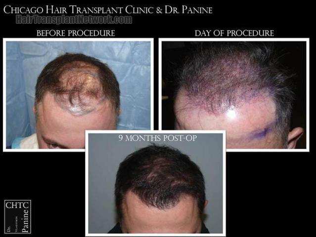 Hair restoration procedure before and after results