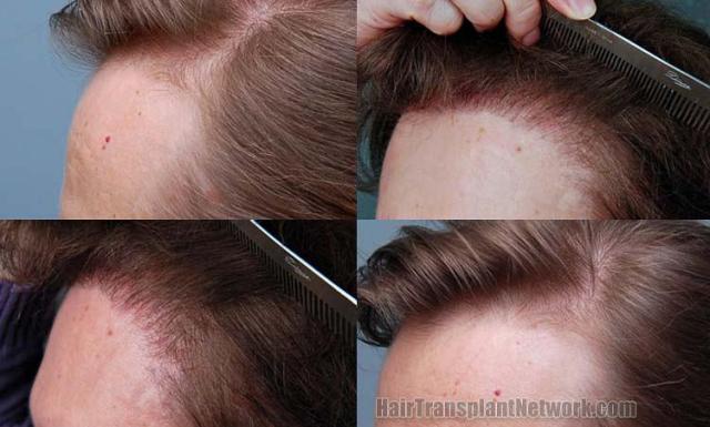 Hair transplantation surgery before and after images