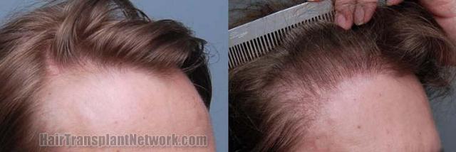 Before and after hair transplant procedure images