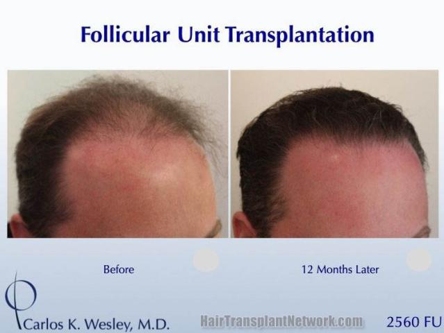 Hair transplantation procedure before and after results