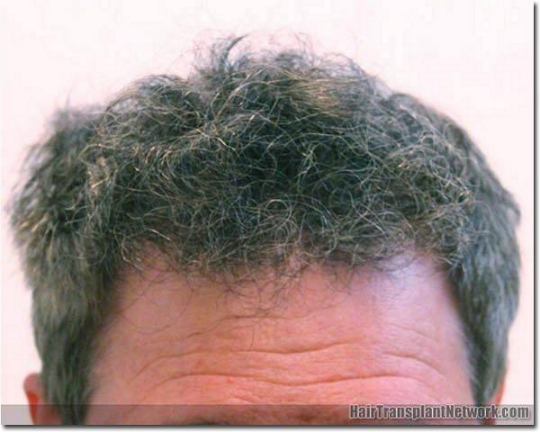 Hair restoration procedure results