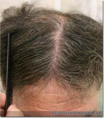 Hair restoration procedure results