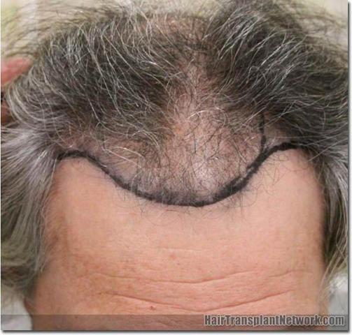 Hair restoration procedure results