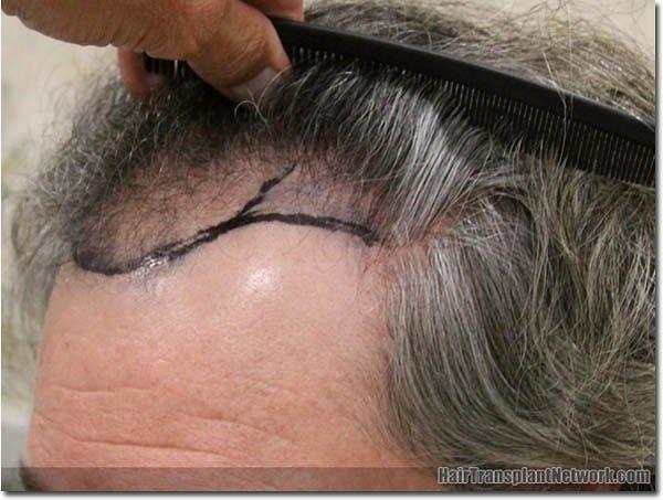 Hair restoration procedure results