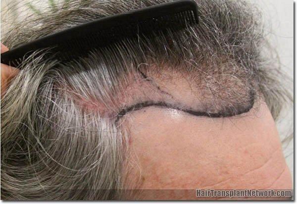 Hair restoration procedure results