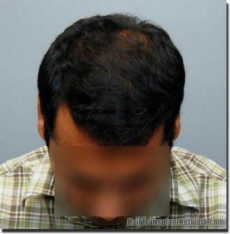 Hair restoration procedure results