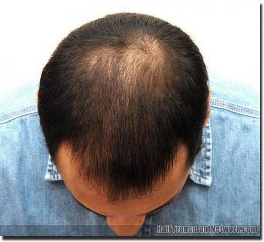 Hair restoration procedure results