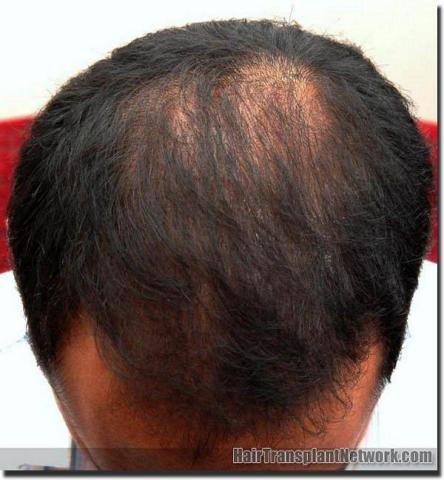 Hair restoration procedure results