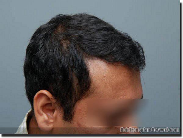 Hair restoration procedure results