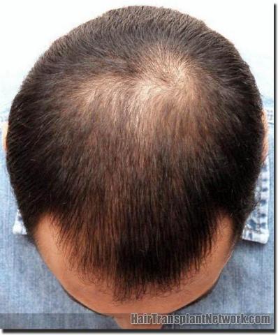 Hair restoration procedure results