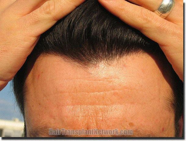 Hair restoration procedure results