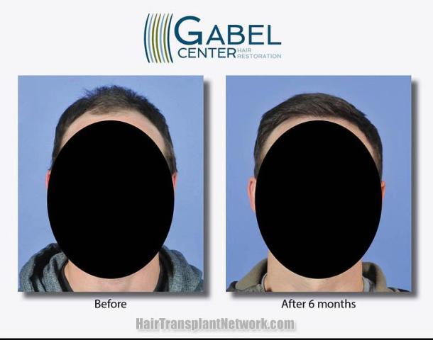 Hair restoration procedure before and after results