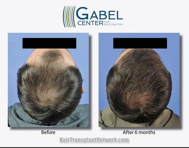 Hair restoration procedure before and after results