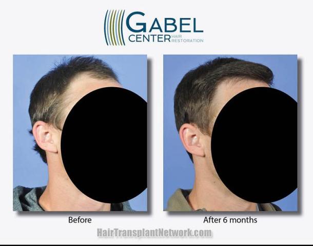 Hair restoration surgery before and after photos