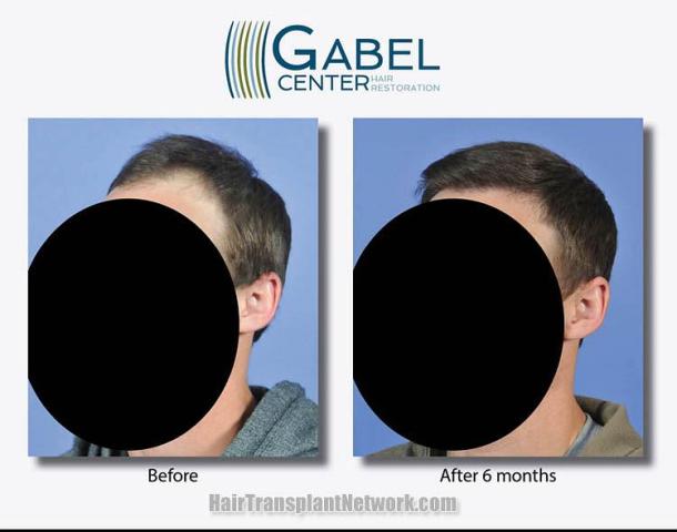 Hair transplantation surgery before and after photos