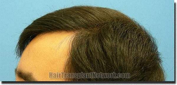 Hair restoration procedure results