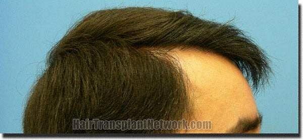 Hair restoration procedure results