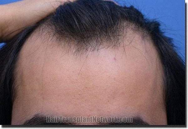 Hair restoration procedure results