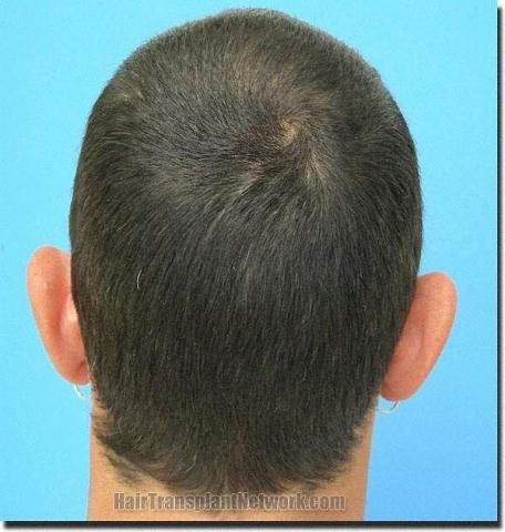 Hair restoration procedure results