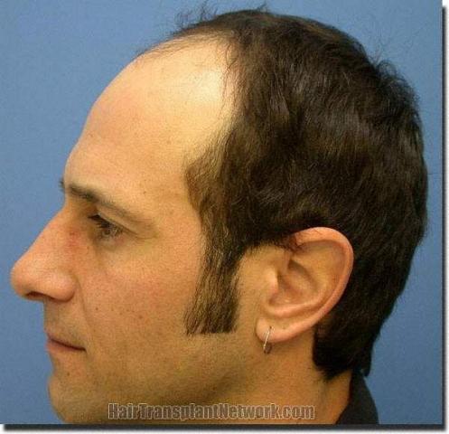 Hair restoration procedure results