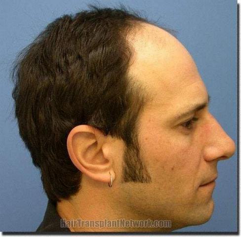 Hair restoration procedure results