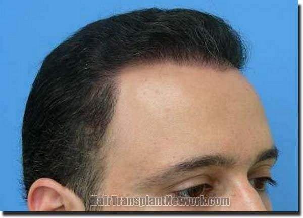 Hair restoration procedure results