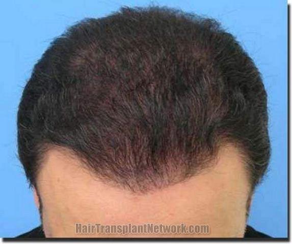 Hair restoration procedure results