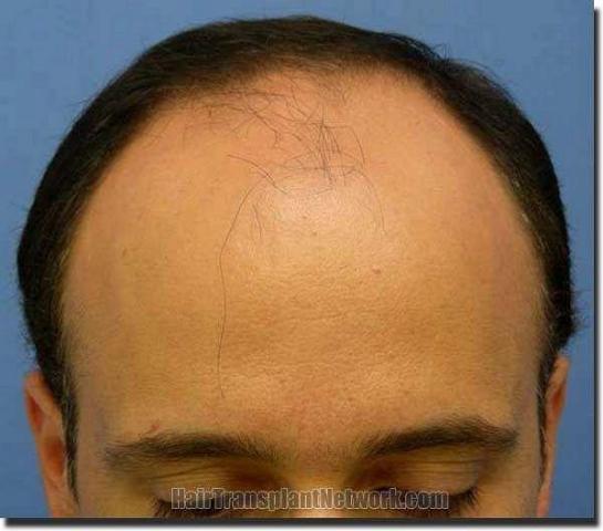 Hair restoration procedure results