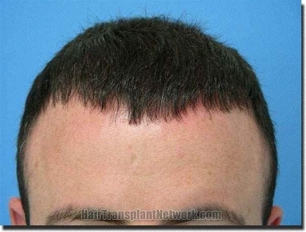 Hair restoration procedure results