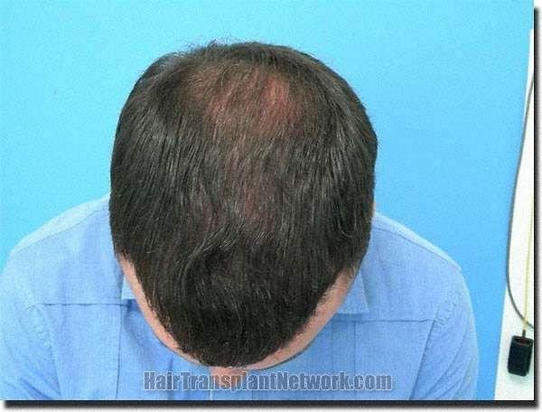 Hair restoration procedure results